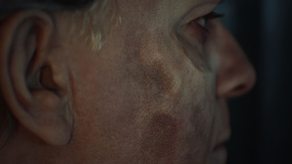 Extreme close-up of a person's profile showing textured skin and dark patches on the cheek.