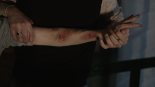 Two hands hold a person's forearm which has red, irritated skin lesions.
