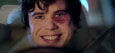 A smiling young man with dark hair and a large purple bruise around his left eye.
