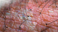 Macro view of pinkish skin texture with several thin, dark hairs growing from pores.