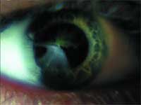 Close-up of a human eye showing green fluorescent dye on the surface of the cornea.